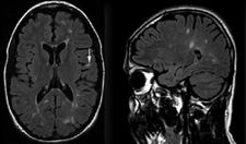 Hiperintens Lezyon Nedir?
