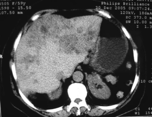 Hipodens Kistik Lezyon Nedenleri