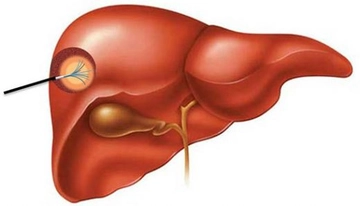Karaciğerde Lezyon Belirtileri ve Tedavisi