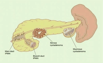 Pankreasta Lezyon Belirtileri ve Tedavisi