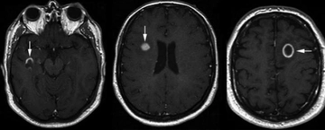 Kitle Lezyonu Nedir?